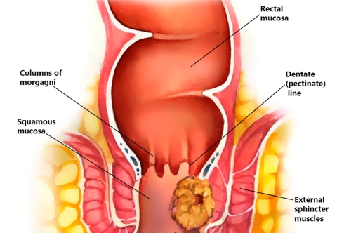 Những dấu hiệu ban đầu của ung thư ống hậu môn là gì?